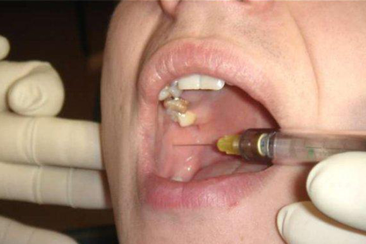 下牙槽神经局麻图 下牙槽神经局麻图