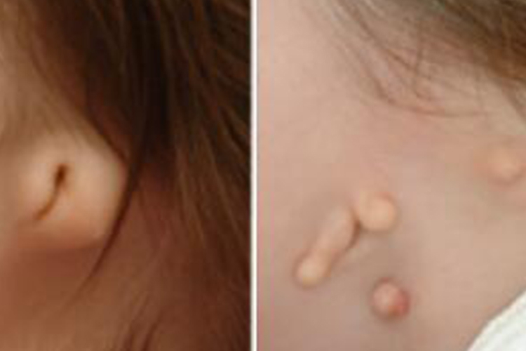 外耳畸形Ⅳ型图