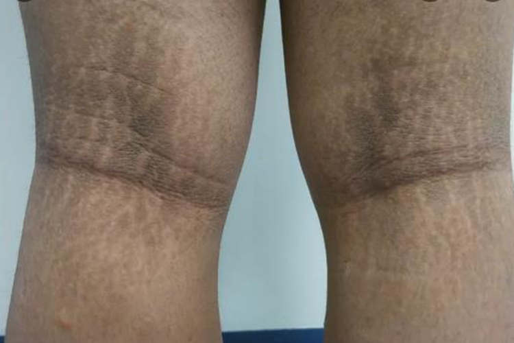 黑棘皮病膝盖后面发黑图 黑棘皮病膝盖后面发黑图