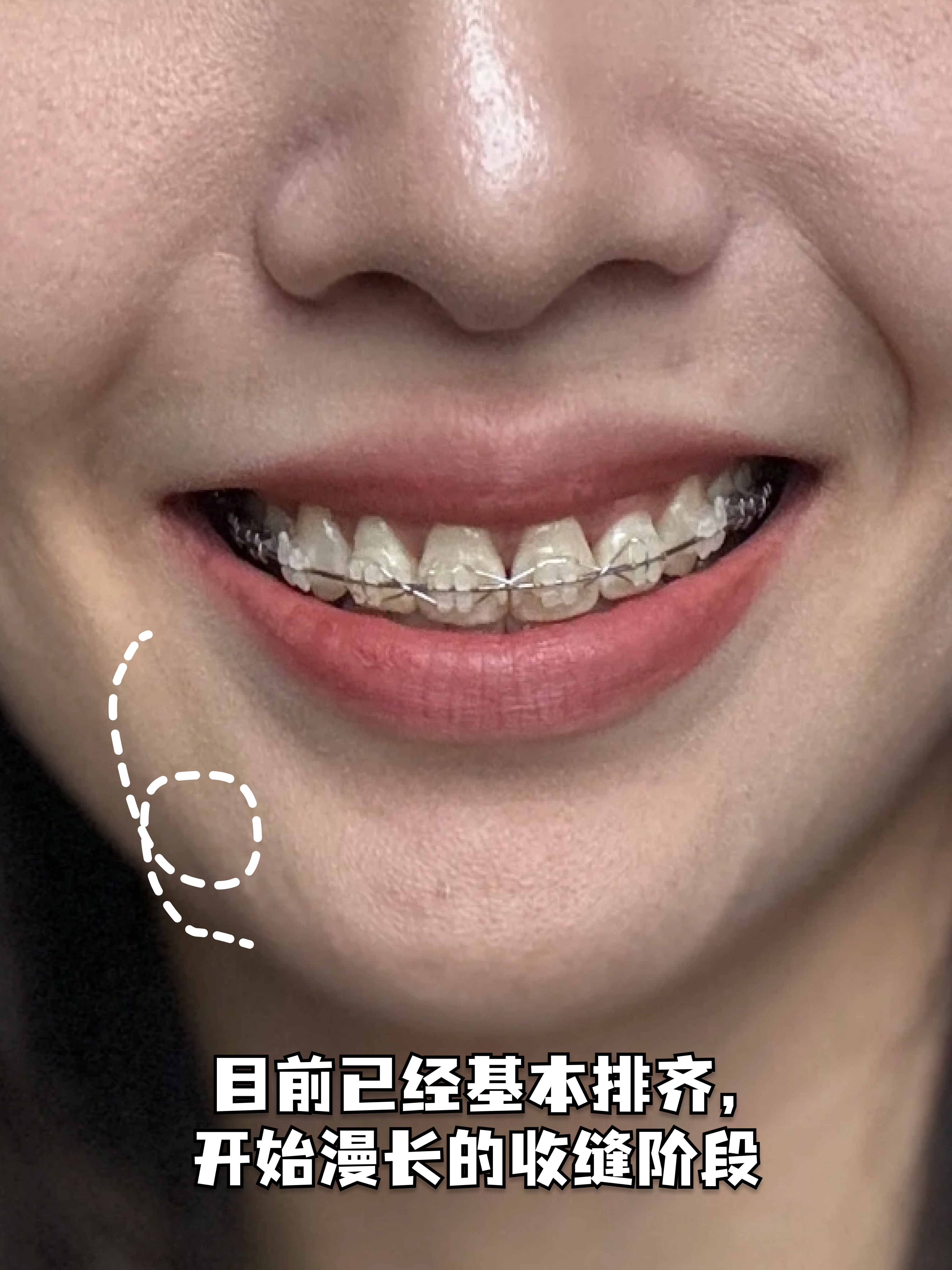 困扰无数人的牙齿开颌,要怎么矫正?