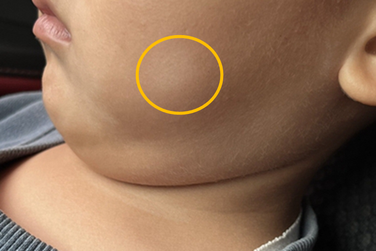 白色糠疹左脸一个小白斑图