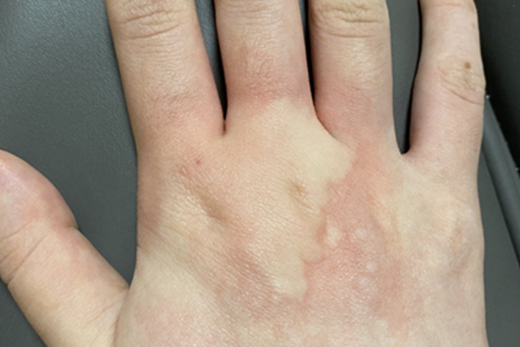 急性自发性荨麻疹手背风团图