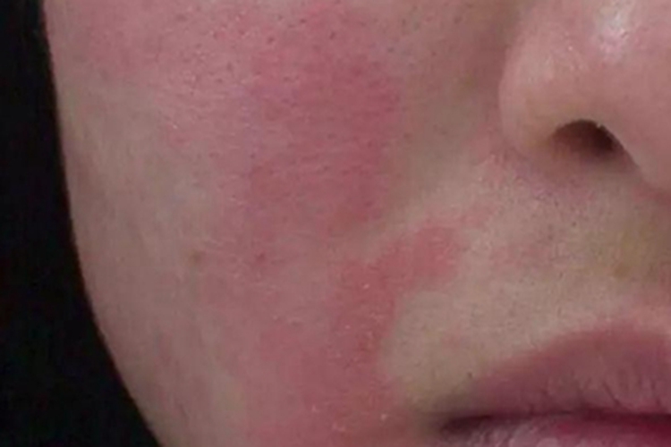 难辨认癣面部症状图