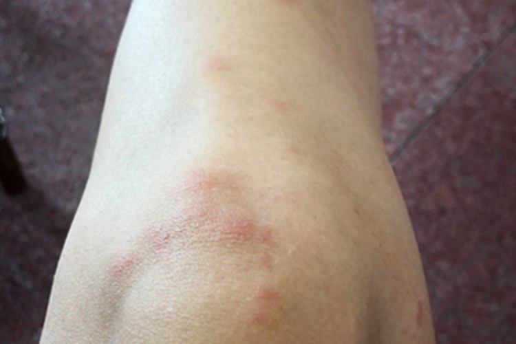 青霉素过敏腿红斑图 青霉素过敏腿红斑图