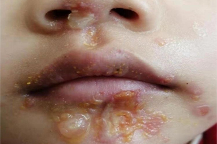 脓疱病口周结痂图
