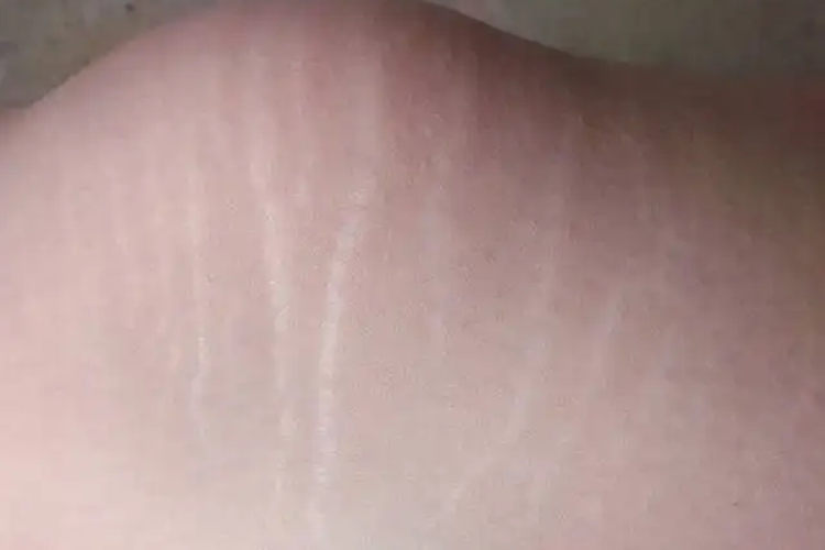 膝盖上有白色条纹图