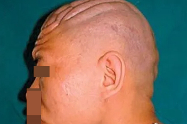 肥大性骨关节病头皮症状图 肥大性骨关节病头皮症状图