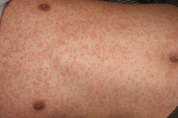 麻疹型或猩红热型药疹图