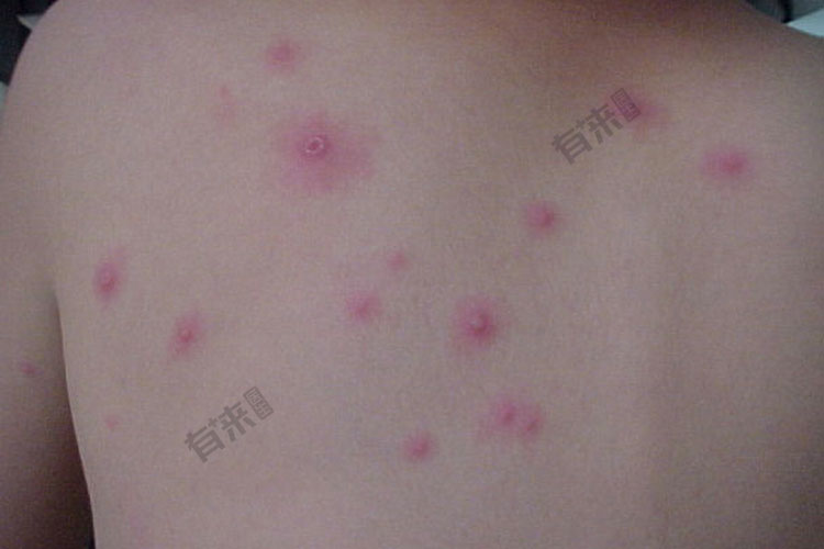 水痘图