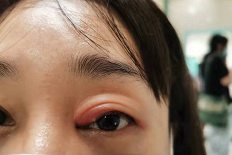 外睑腺炎症状图 外睑腺炎症状图