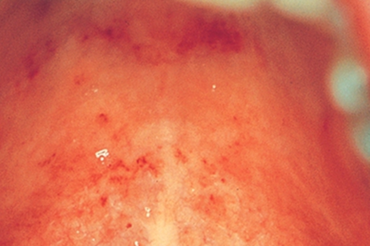 风疹口腔红点图