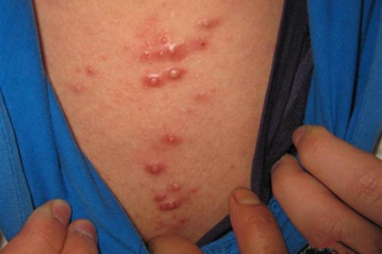 痤疮胸部症状图 痤疮胸部症状图