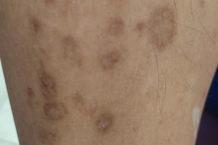 汗孔角化症小腿黑斑图 汗孔角化症小腿黑斑图