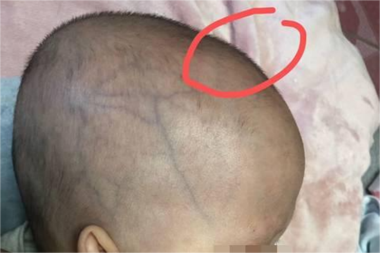 宝宝前囟门饱满侧面图