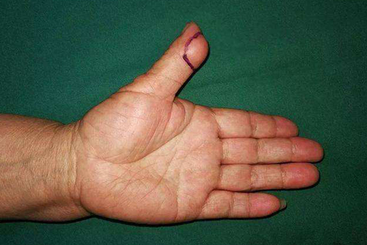 大拇指皮肤纤维瘤图