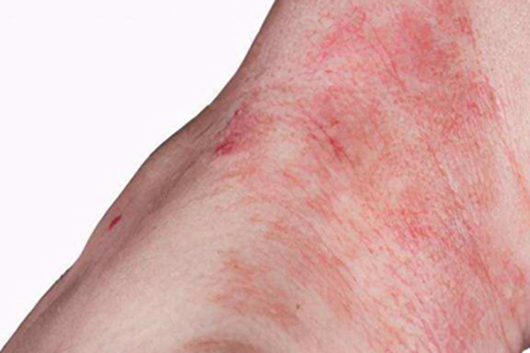 日光性皮炎斑图