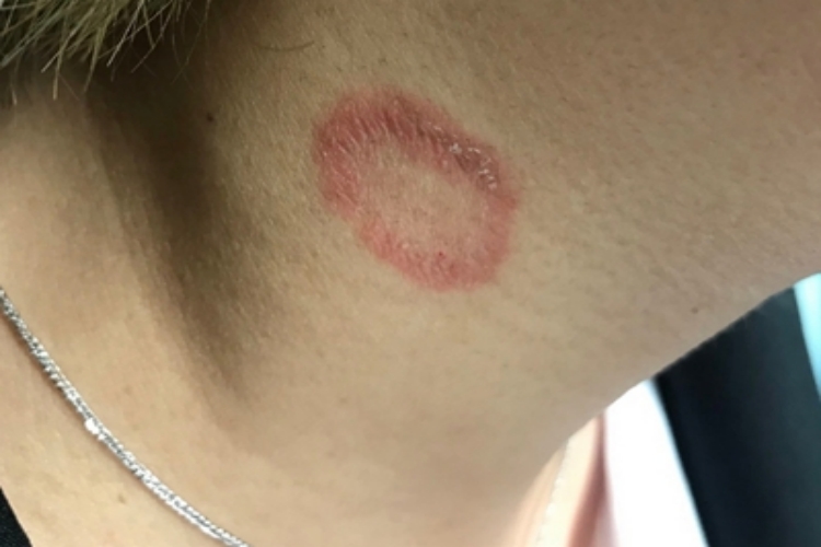 远心性环状红斑脱屑图