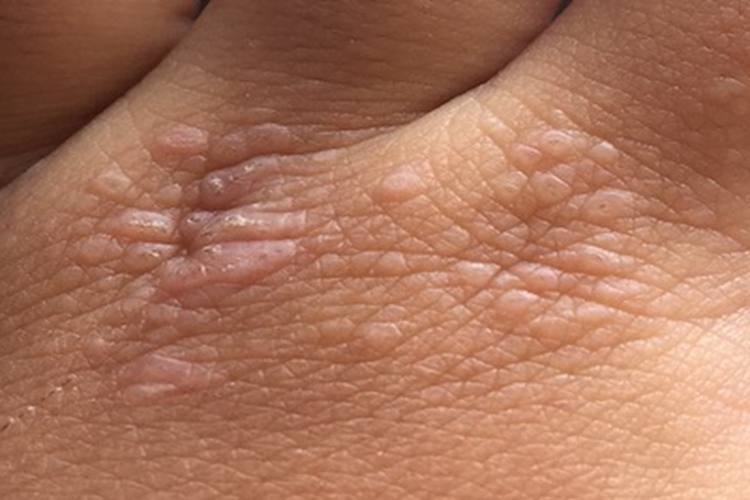 幼年型皮肌炎手背丘疹图 幼年型皮肌炎手背丘疹图