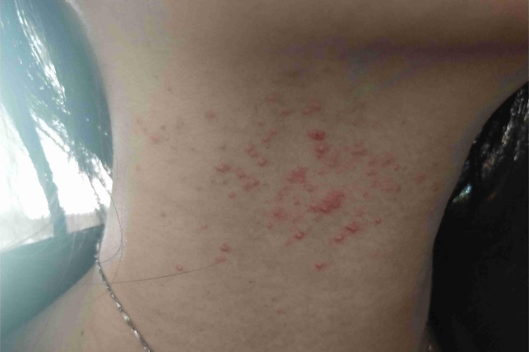 细菌性毛囊炎侧颈症状图 细菌性毛囊炎侧颈症状图