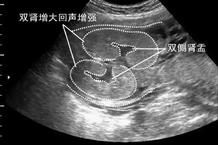 胎儿双肾增大超声图