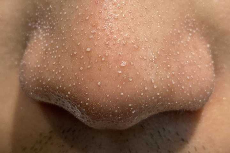 粉刺鼻子白头粉刺图 粉刺鼻子白头粉刺图