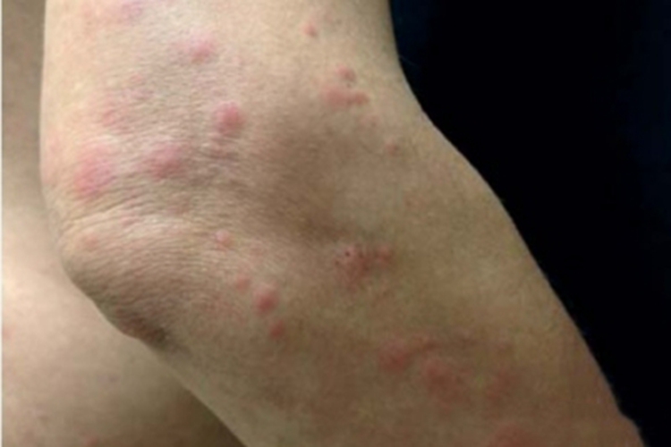 螨虫皮炎胳膊很多丘疹图