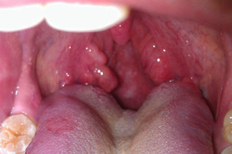 三期梅毒咽喉疙瘩图