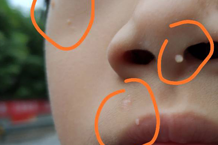 面部丝状疣图 面部丝状疣图