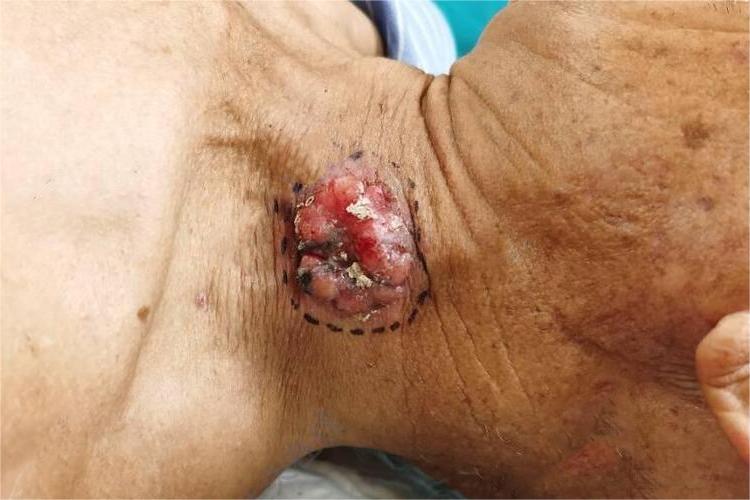 皮肤鳞状细胞癌侧颈症状图