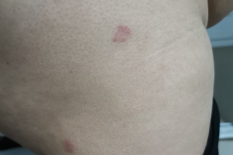 体癣臀部侧面两块红斑图