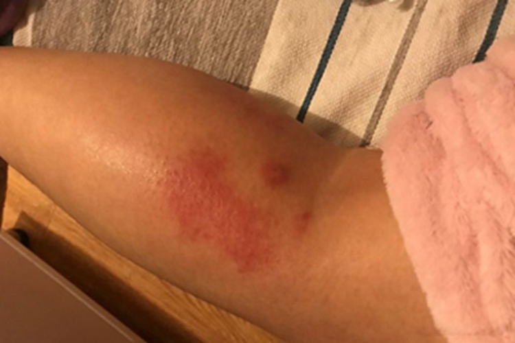 蜂蜇伤小腿上红了一片图 蜂蜇伤小腿上红了一片图