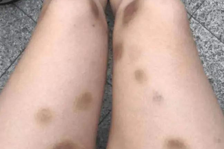 维生素K缺乏皮肤淤斑图