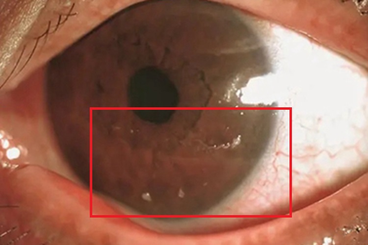棘阿米巴角膜炎肉赘图