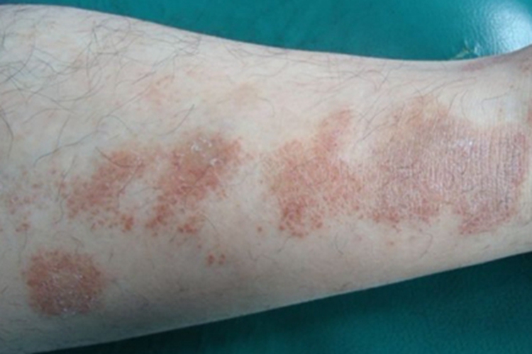 湿疹样紫癜小腿症状图