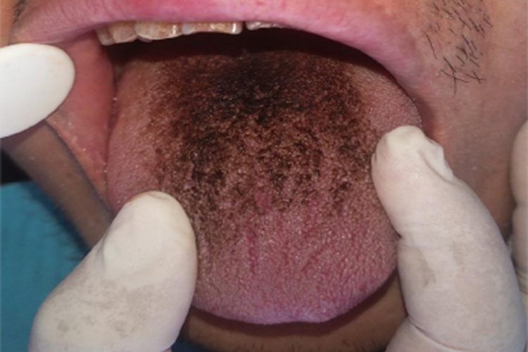 毛舌舌头前面发黑图 毛舌舌头前面发黑图