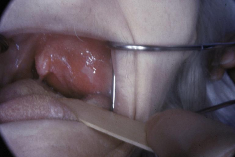 扁桃体周脓肿图