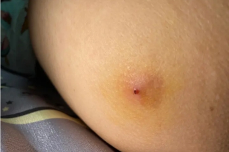 皮脂腺囊肿腹部疙瘩图