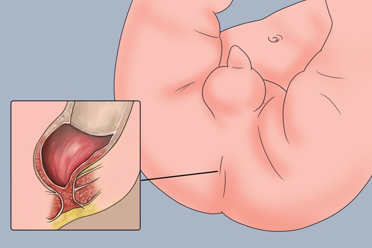 肛门闭锁肛门畸形图