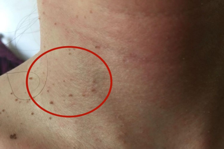 多发性皱纹状小丘疹颈部小疙瘩图 多发性皱纹状小丘疹颈部小疙瘩图