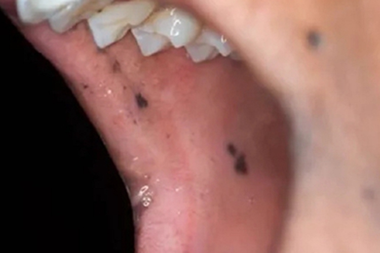 色素沉着息肉综合征口腔黑斑图 色素沉着息肉综合征口腔黑斑图