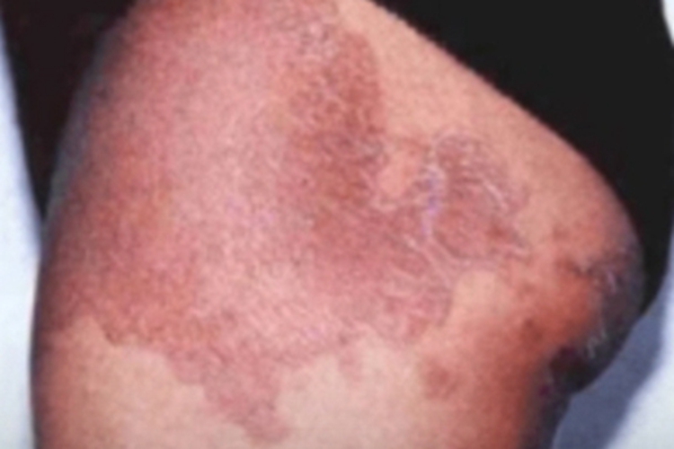 红绀病大腿症状图 红绀病大腿症状图