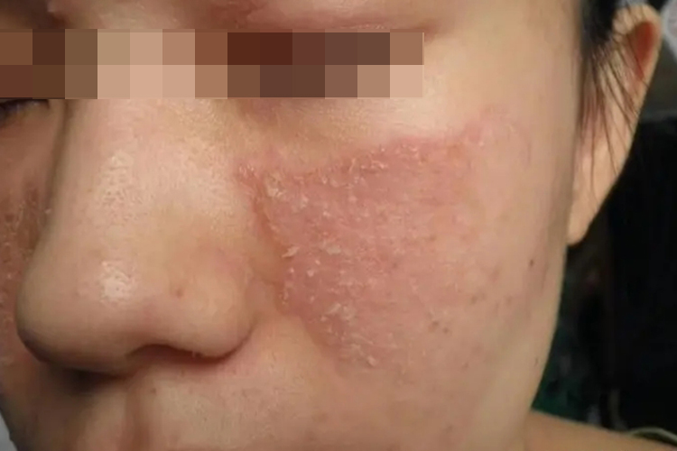 干性型脸上面游风图