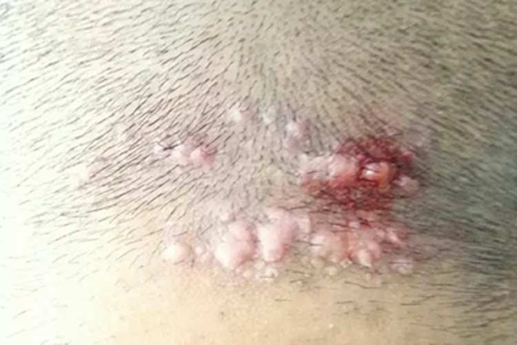 秃发性毛囊炎头皮疹子图 秃发性毛囊炎头皮疹子图