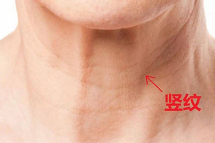 颈竖纹图