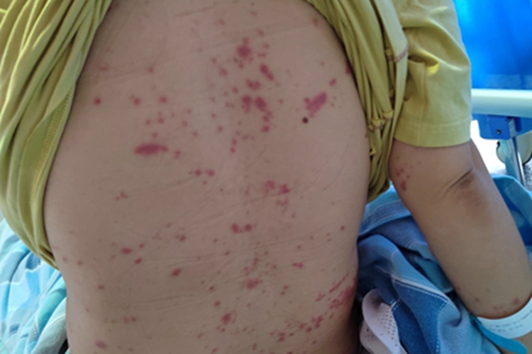 紫癜型药疹背部有红点图