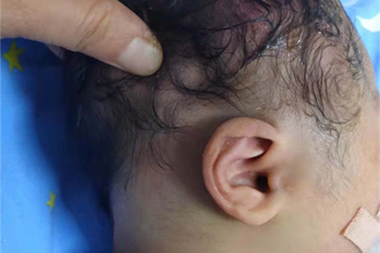 皮下血肿头皮红肿图