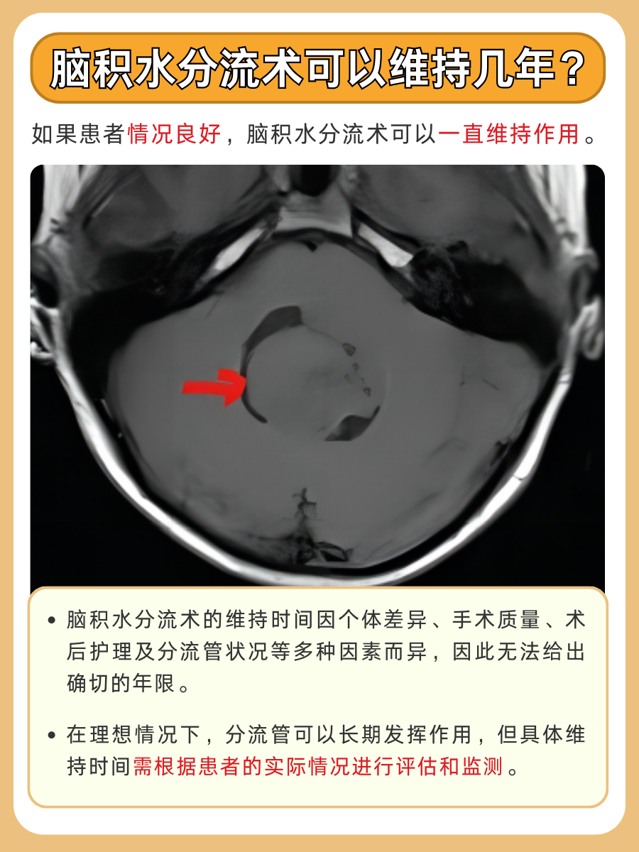脑积水分流术,效果维持时限到底是多少?