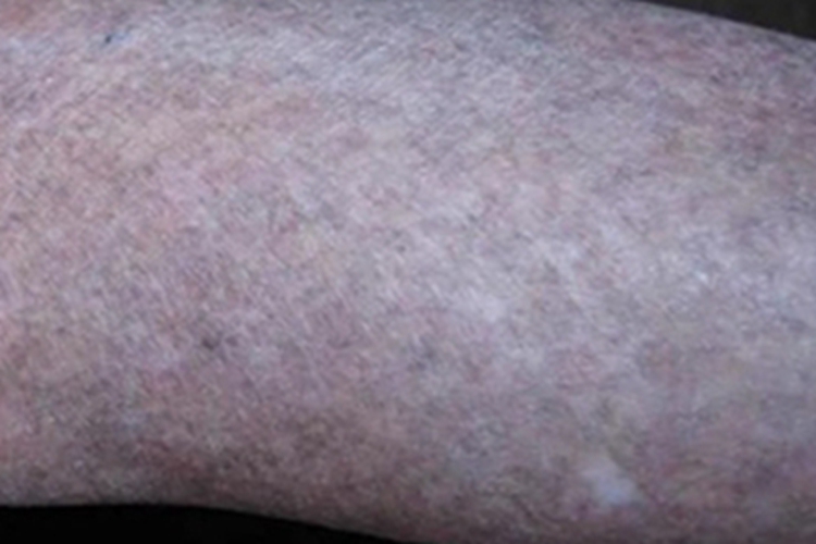 苔藓样型副银屑病胳膊皮肤萎缩图