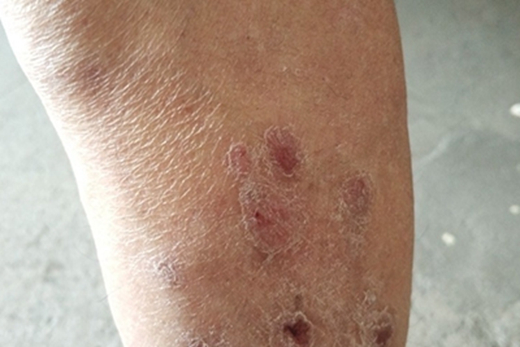 寻常型银屑病小腿脱屑图