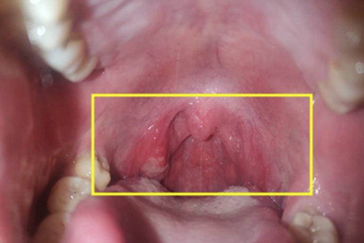 慢性扁桃体炎咽喉小红疙瘩图